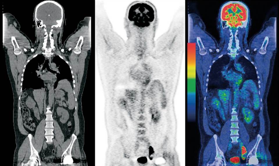 Что такое пэт кт в онкологии
